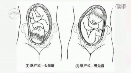 26.四步触诊