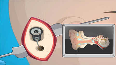 模拟耳科手术 人工植入接受刺激器