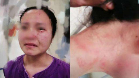 广州通报外籍新冠肺炎患者打伤护士 已立刑事案件调查