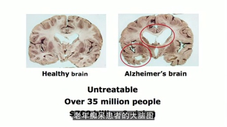 利用大脑自我修复能力治疗MS,ALS等神经