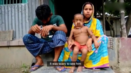 现实版《返老还童》 孟加拉四岁男孩面容宛如老翁 160731