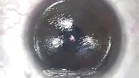 中国近视网www.zgjsyw.com近视激光手术