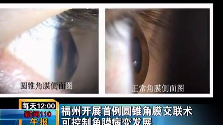 新闻110报道:福州眼科医院救治圆锥角膜患者