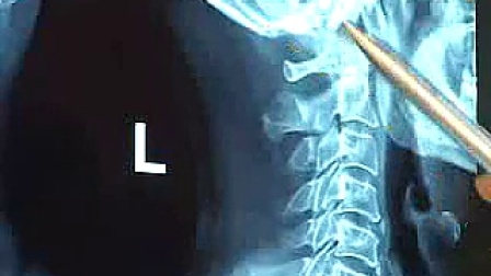X光片CT