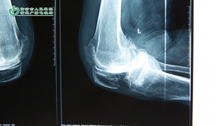 临汾市人民医院关节外科-3d打印膝关节置换术