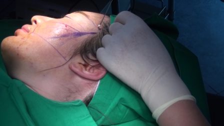 麦西美嘉大v脸手术操作