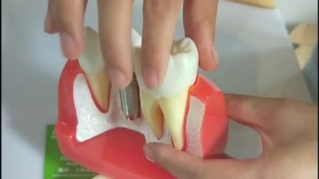 烁蒂医疗牙科4倍种植牙模型口腔牙模