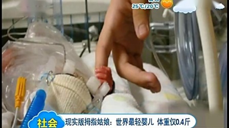 现实版拇指姑娘：世界最轻婴儿 体重仅0