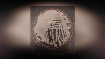 中国确诊18例超级真菌感染:真菌致死率60% 被